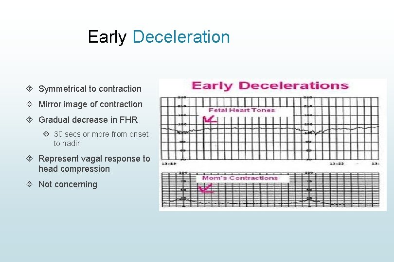 Early Deceleration Symmetrical to contraction Mirror image of contraction Gradual decrease in FHR 30