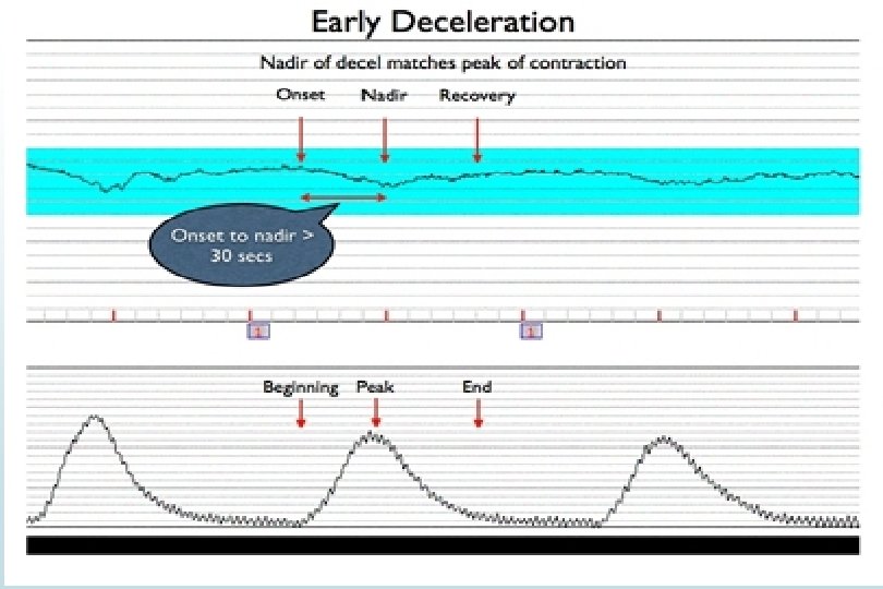 EARLY DECELERATION v Gradual FHR decrease v Onset to nadir 30 seconds or more EARLY DECELERATION v Gradual FHR decrease v Onset to nadir 30 seconds or more
