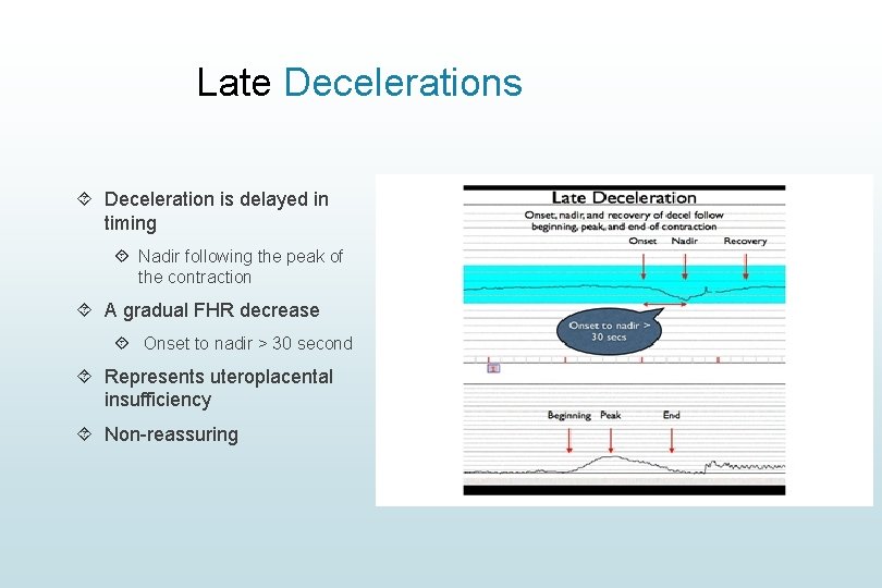 Late Decelerations Deceleration is delayed in timing Nadir following the peak of the contraction