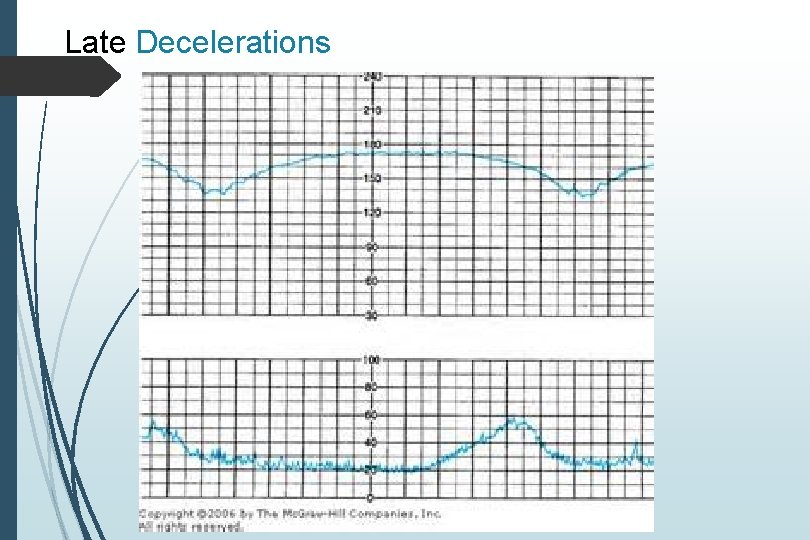 Late Decelerations Late Decelerations