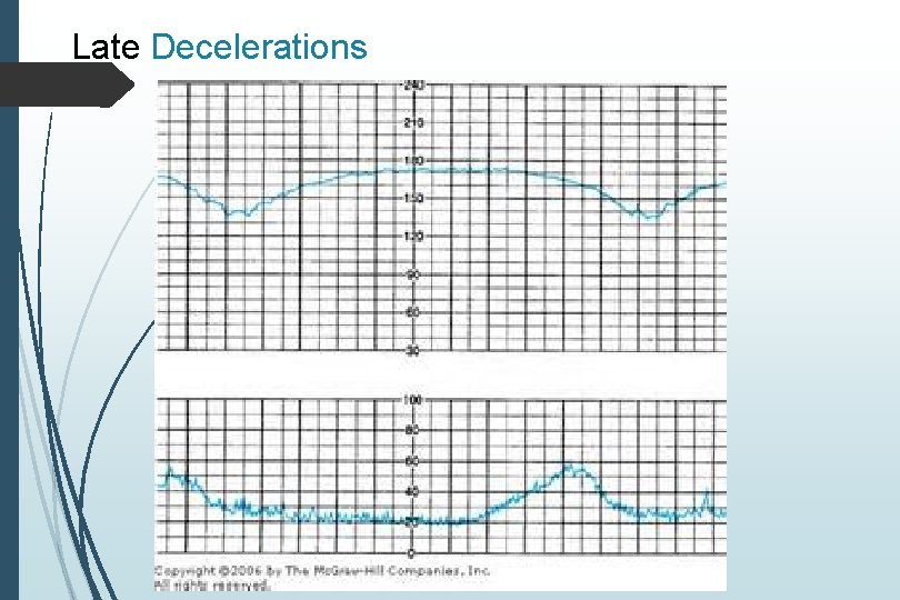 Late Decelerations 