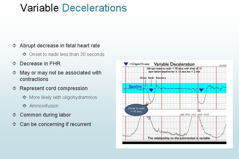 Variable Decelerations Abrupt decrease in fetal heart rate Onset to nadir less than 30 Variable Decelerations Abrupt decrease in fetal heart rate Onset to nadir less than 30