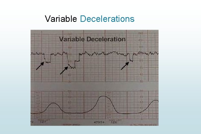 Variable Decelerations Variable Decelerations