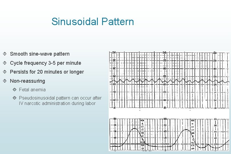 Sinusoidal Pattern Smooth sine-wave pattern Cycle frequency 3 -5 per minute Persists for 20