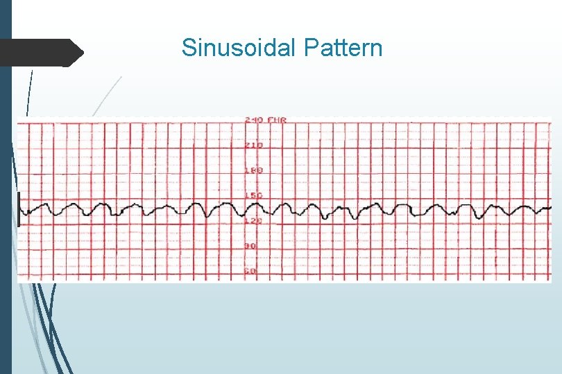 Sinusoidal Pattern 
