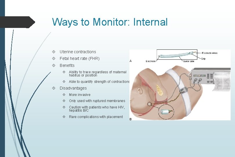 Ways to Monitor: Internal Uterine contractions Fetal heart rate (FHR) Benefits Ability to trace Ways to Monitor: Internal Uterine contractions Fetal heart rate (FHR) Benefits Ability to trace