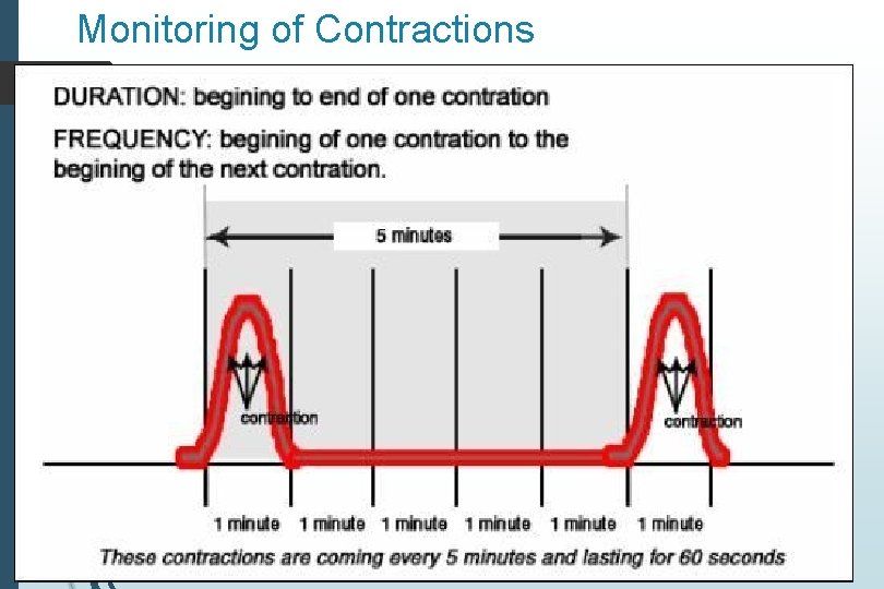 Monitoring of Contractions 