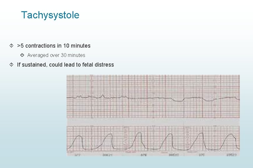Tachysystole >5 contractions in 10 minutes Averaged over 30 minutes If sustained, could lead