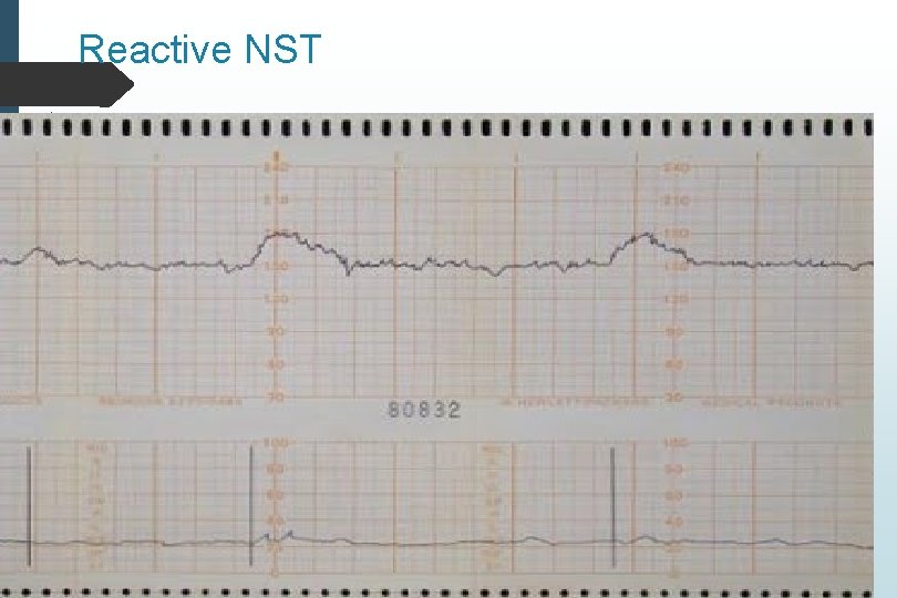 Reactive NST Reactive NST