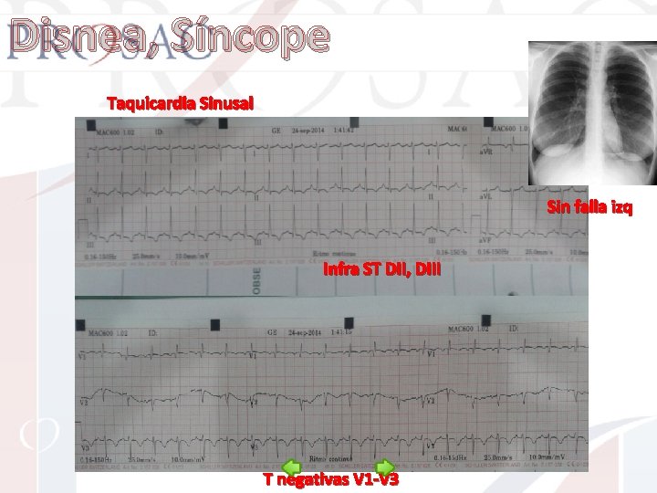 Disnea, Síncope Taquicardia Sinusal Sin falla izq Infra ST DII, DIII T negativas V