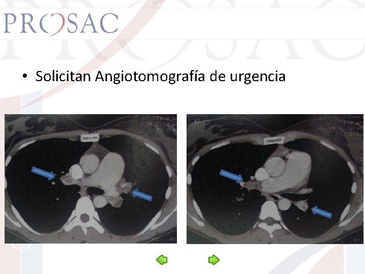  • Solicitan Angiotomografía de urgencia 