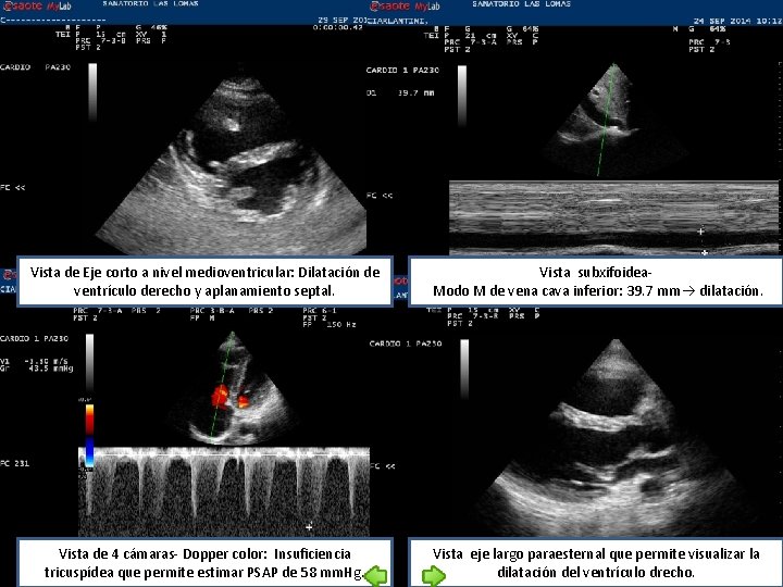Vista de Eje corto a nivel medioventricular: Dilatación de ventrículo derecho y aplanamiento septal.