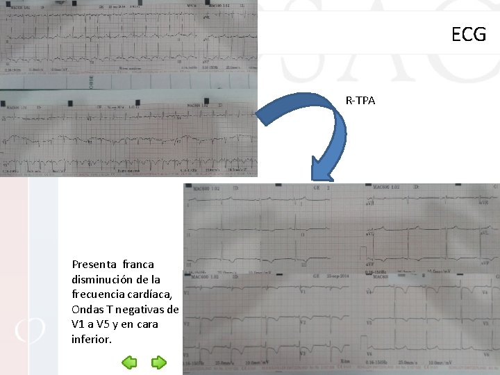 ECG R-TPA Presenta franca disminución de la frecuencia cardíaca, Ondas T negativas de V