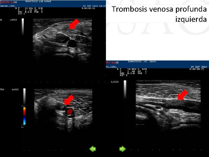 Trombosis venosa profunda izquierda 