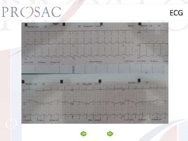 ECG 