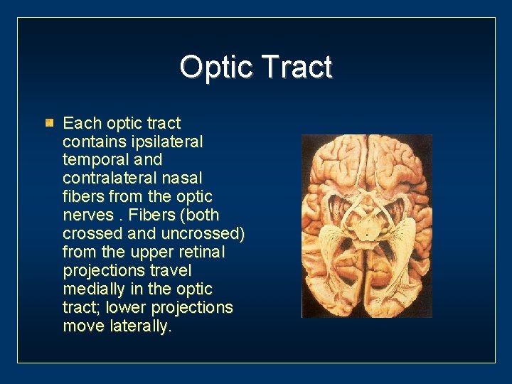 Optic Tract Each optic tract contains ipsilateral temporal and contralateral nasal fibers from the