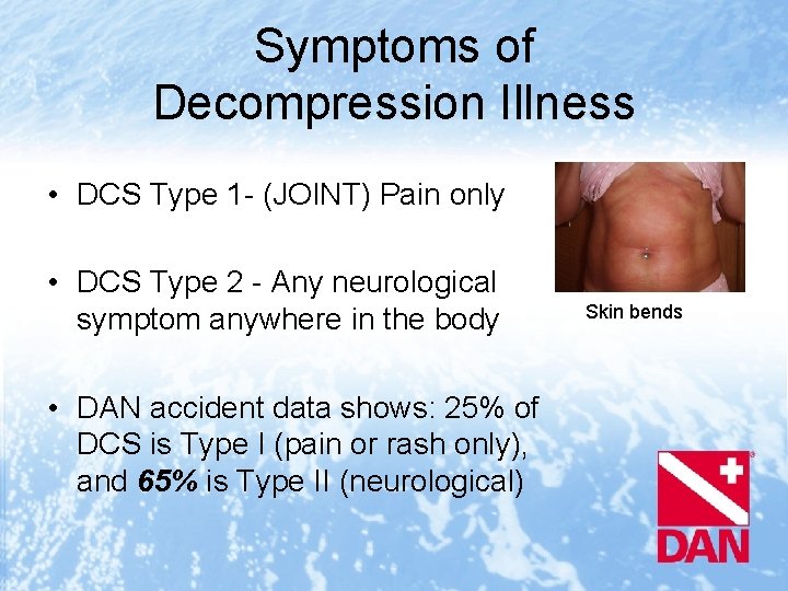 Symptoms of Decompression Illness • DCS Type 1 - (JOINT) Pain only • DCS