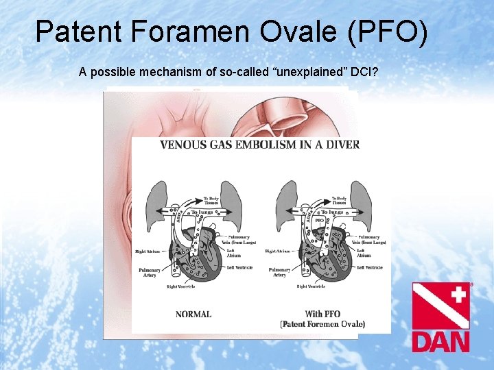 Patent Foramen Ovale (PFO) A possible mechanism of so-called “unexplained” DCI? 