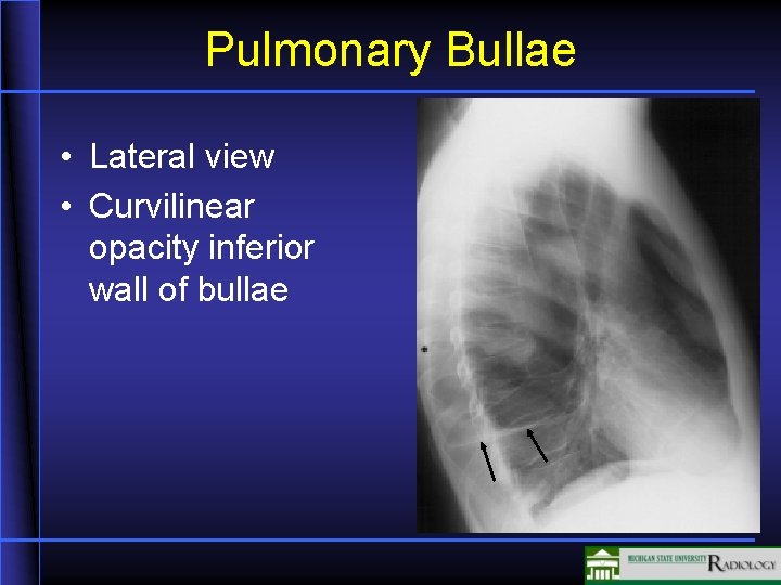 Pulmonary Bullae • Lateral view • Curvilinear opacity inferior wall of bullae 