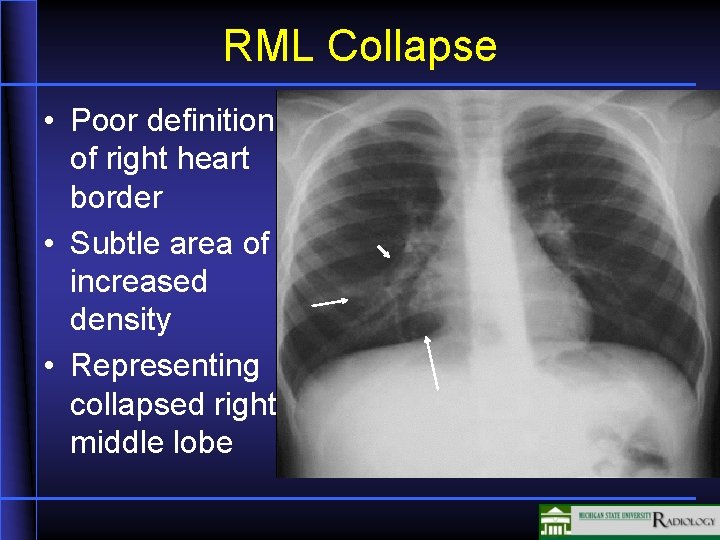 RML Collapse • Poor definition of right heart border • Subtle area of increased