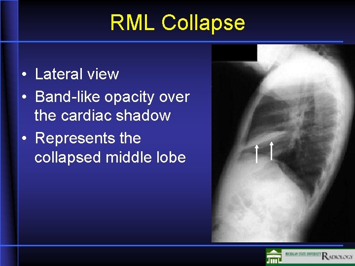 RML Collapse • Lateral view • Band-like opacity over the cardiac shadow • Represents