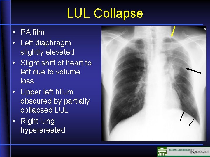 LUL Collapse • PA film • Left diaphragm slightly elevated • Slight shift of