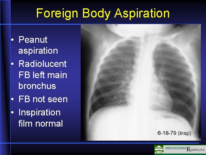 Foreign Body Aspiration • Peanut aspiration • Radiolucent FB left main bronchus • FB
