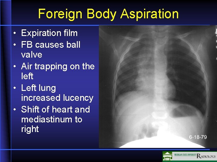 Foreign Body Aspiration • Expiration film • FB causes ball valve • Air trapping
