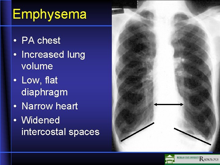 Emphysema • PA chest • Increased lung volume • Low, flat diaphragm • Narrow