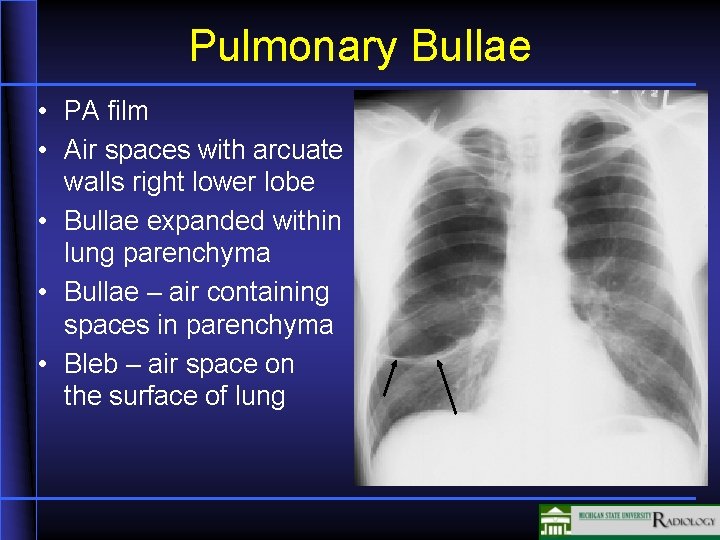 Pulmonary Bullae • PA film • Air spaces with arcuate walls right lower lobe