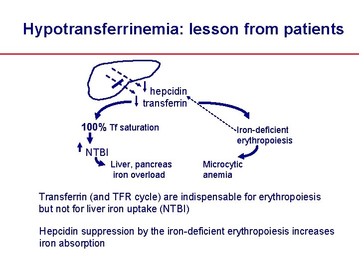 Hypotransferrinemia: lesson from patients hepcidin transferrin 100% Tf saturation Iron-deficient erythropoiesis NTBI Liver, pancreas