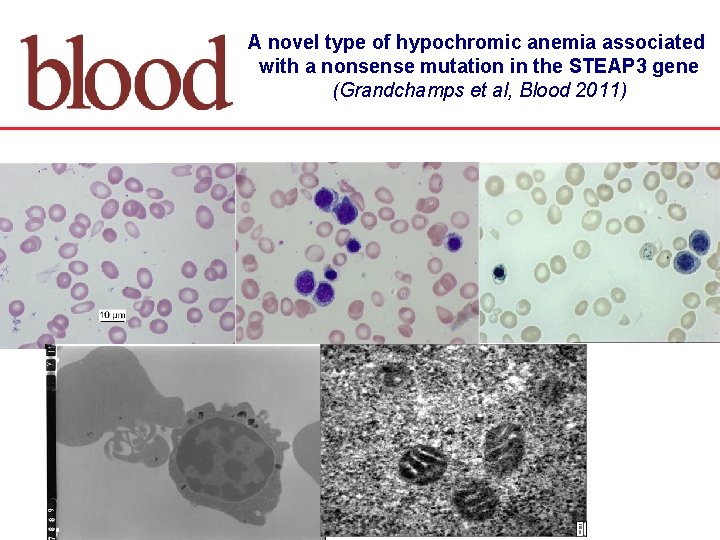 A novel type of hypochromic anemia associated with a nonsense mutation in the STEAP
