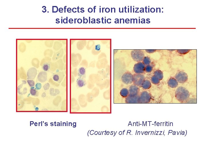 3. Defects of iron utilization: sideroblastic anemias Perl’s staining Anti-MT-ferritin (Courtesy of R. Invernizzi,