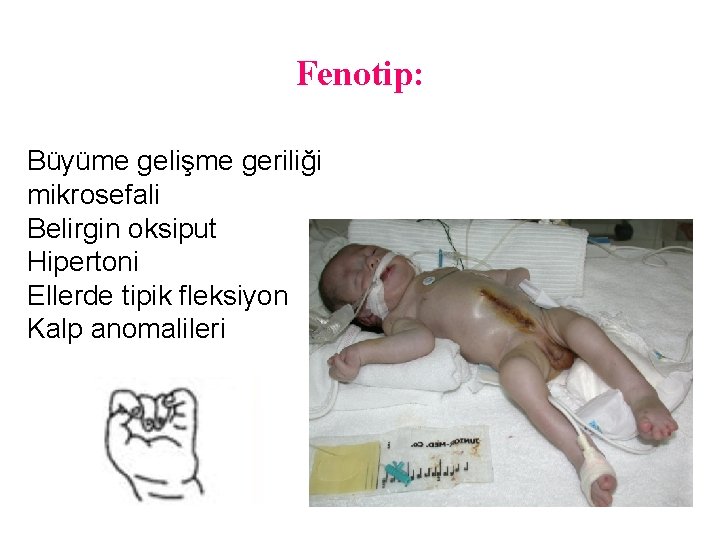 Fenotip: Büyüme gelişme geriliği mikrosefali Belirgin oksiput Hipertoni Ellerde tipik fleksiyon Kalp anomalileri 