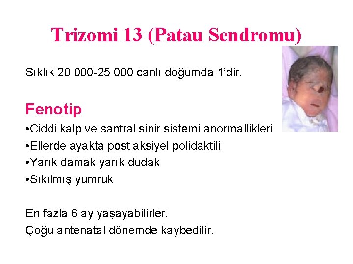 Trizomi 13 (Patau Sendromu) Sıklık 20 000 -25 000 canlı doğumda 1’dir. Fenotip •