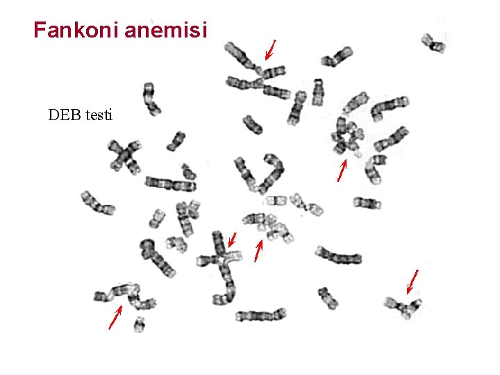 Fankoni anemisi DEB testi 