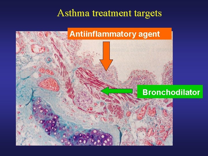 Asthma treatment targets Antiinflammatory agent Bronchodilator 