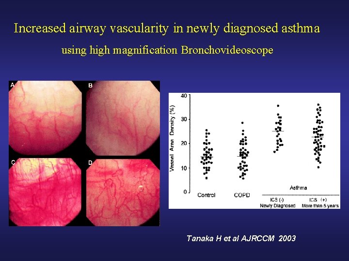 Increased airway vascularity in newly diagnosed asthma using high magnification Bronchovideoscope Tanaka H et