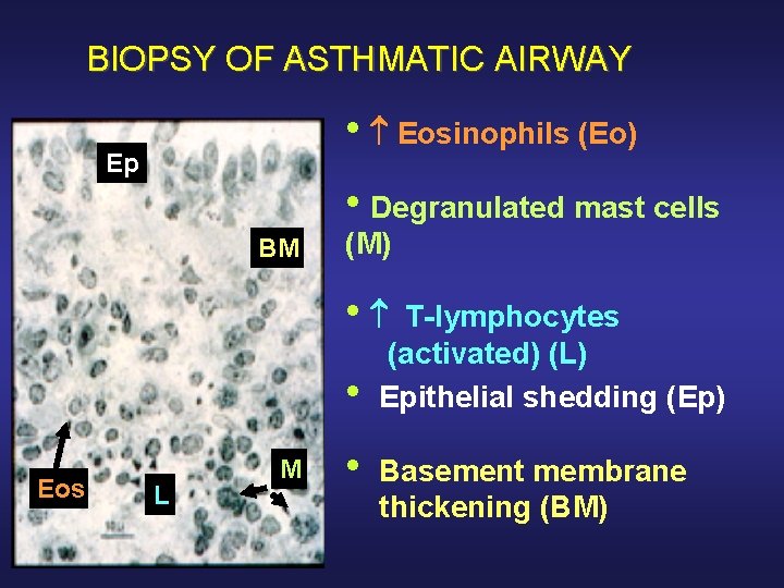 BIOPSY OF ASTHMATIC AIRWAY • Eosinophils (Eo) Ep • Degranulated mast cells BM (M)