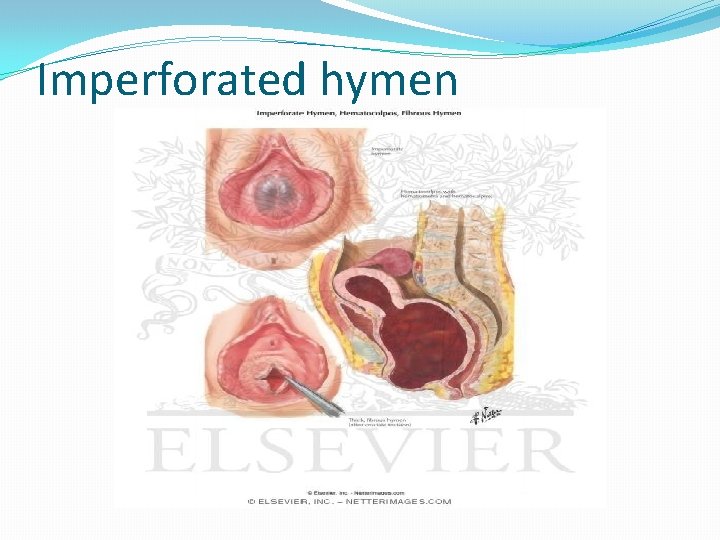 Imperforated hymen 