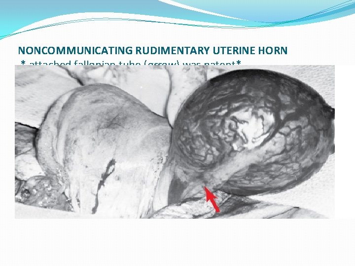 NONCOMMUNICATING RUDIMENTARY UTERINE HORN * attached fallopian tube (arrow) was patent* 
