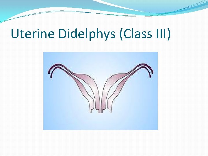 Uterine Didelphys (Class III) 