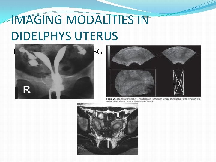 IMAGING MODALITIES IN DIDELPHYS UTERUS HSG 3 DUSG MRI 