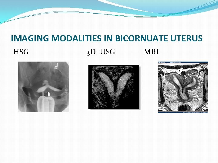 IMAGING MODALITIES IN BICORNUATE UTERUS HSG 3 D USG MRI 