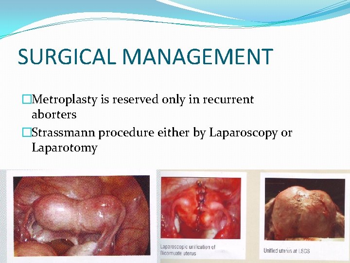 SURGICAL MANAGEMENT �Metroplasty is reserved only in recurrent aborters �Strassmann procedure either by Laparoscopy