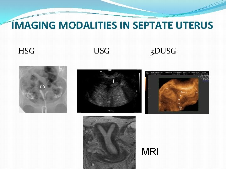 IMAGING MODALITIES IN SEPTATE UTERUS HSG USG 3 DUSG MRI 