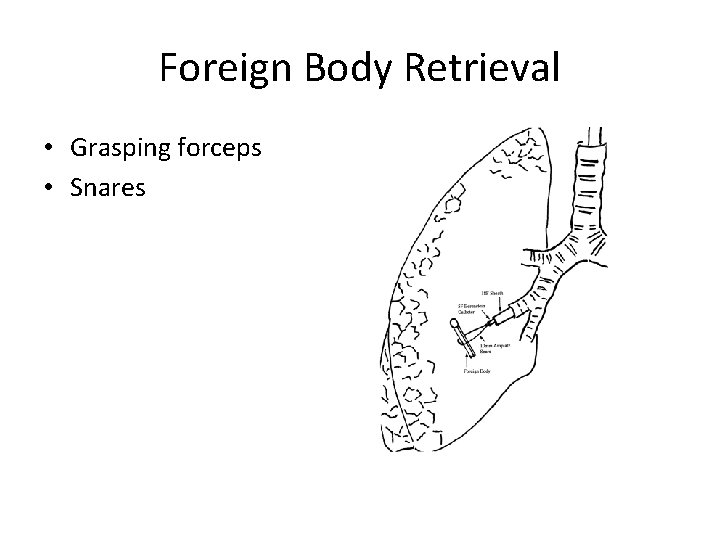 Foreign Body Retrieval • Grasping forceps • Snares 