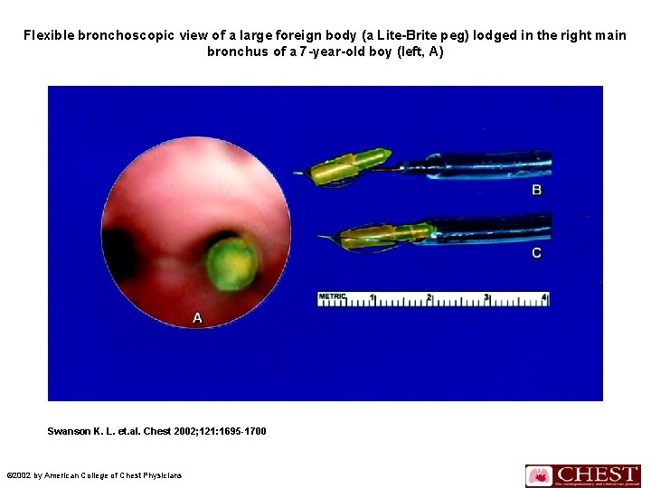 Flexible bronchoscopic view of a large foreign body (a Lite-Brite peg) lodged in the