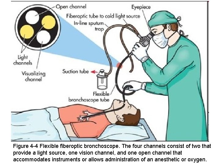 Figure 4 -4 Flexible fiberoptic bronchoscope. The four channels consist of two that provide