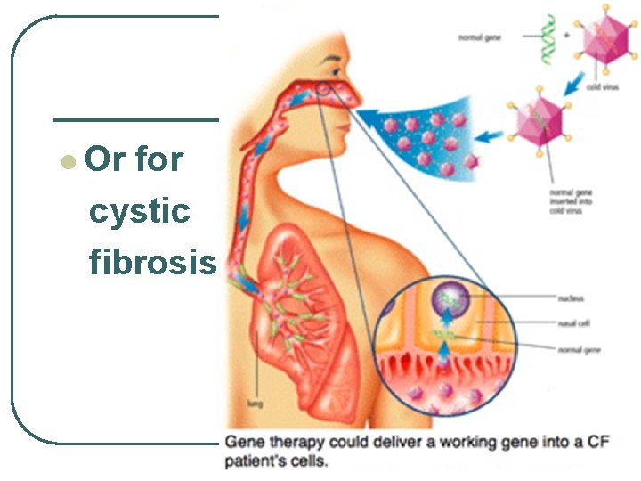 l Or for cystic fibrosis 